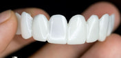FlexiSmile Dentures with Natural White Lenses for a Comfortable and Elegant Smile 3