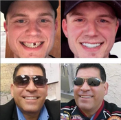 Snap-On Dentures for a Natural Smile Enhancement 5